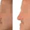 Rhinoplasty (Nose Job)