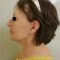 Facelift, SMAS Facelift