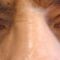 Eyelid surgery (Blepharoplasty)