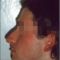 Plastika nosu (Rhinoplastika)