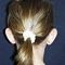 Ear surgery (Otoplasty)