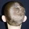 Ear surgery (Otoplasty)
