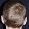 Ear surgery (Otoplasty)