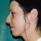 Plastika nosu (Rhinoplastika)