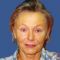 Facelift (operace obličeje), SMAS lifting