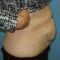 Abdominoplastika (Operace břicha)