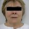 Facelift (operace obličeje), SMAS lifting