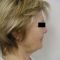 Facelift (operace obličeje), SMAS lifting