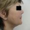 Facelift (operace obličeje), SMAS lifting