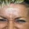 Nichtchirurgische Faltenbehandlung - BOTOX® / DYSPORT®
