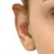 Ear surgery (Otoplasty)