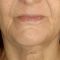 Facelift