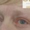 Eyelid surgery (Blepharoplasty)