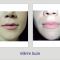 Hyaluronic acid-based wrinkle fillers