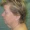 Facelift (operace obličeje), SMAS lifting