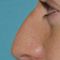 Plastika nosu (Rhinoplastika)