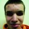 Laser acne treatment