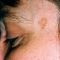 Tattoo removal