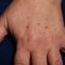 Tattoo removal