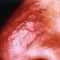 Spider veins laser removal (redness, birh marks)