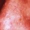 Spider veins laser removal (redness, birh marks)