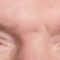 BOTOX®