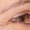 BOTOX®