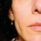 Kwas hialuronowy: Saypha, Restylane, Juvederm, Stylage
