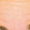 BOTOX®