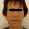 Facelift (operace obličeje), SMAS lifting