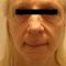 Facelift (operace obličeje), SMAS lifting