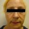 Facelift (operace obličeje), SMAS lifting