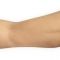 Arm Lift Surgery
