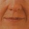 Injekcijska punila - Dysport, Restylane, Botox, Bio Alcamid…
