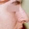 Rinoplastika (operacija nosa)