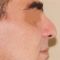Rinoplastika (operacija nosa)