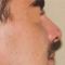 Rinoplastika (operacija nosa)
