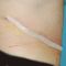 Abdominoplastika (Operace břicha)
