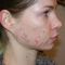 Laser acne treatment