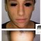 Lipofilling ou autogreffe de tissu graisseux