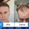 Hair Transplant