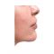 Lip Lift