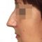 Plastika nosu (Rhinoplastika)