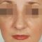 Plastika nosu (Rhinoplastika)