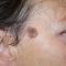 Mole removal