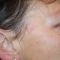 Mole removal