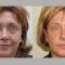 BOTOX®