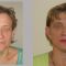 BOTOX®
