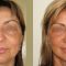 BOTOX®