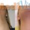 Laser hair removal